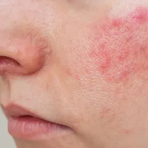 Blemish Control Facial