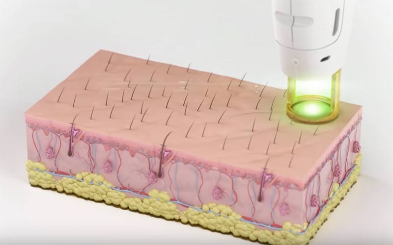 Laser Hair Removal Image 1