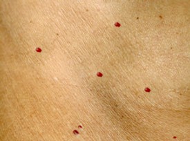 Cherry Haemangiomas