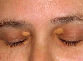 Cholesterol Deposits