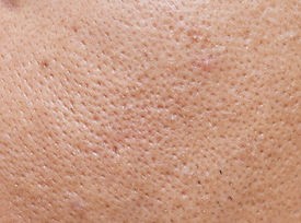 Congested Pores