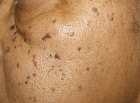 Dermatosis Papulosa Nigra