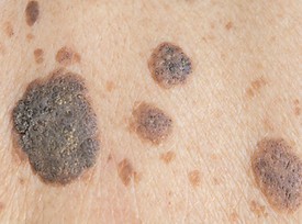 Keratosis