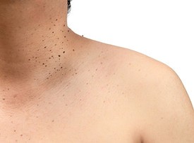 Skin Tags