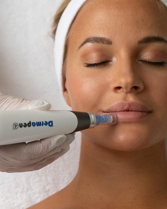 Derma-Pen Micro Needling 3
